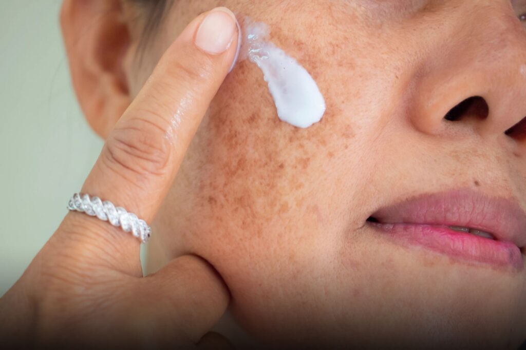 Qual Principia para Melasma: Descubra agora