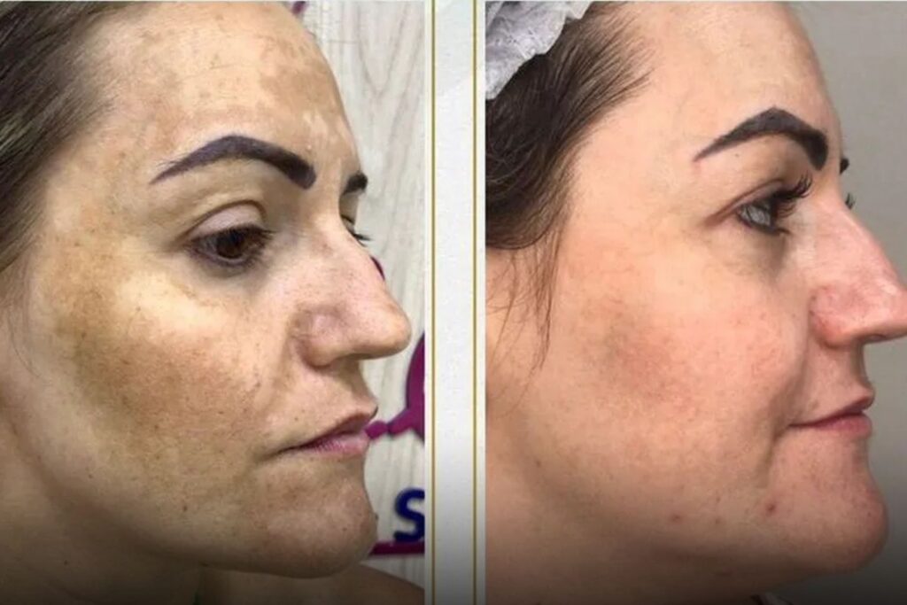 Principia melasma funciona: Principia melasma antes e depois, confira