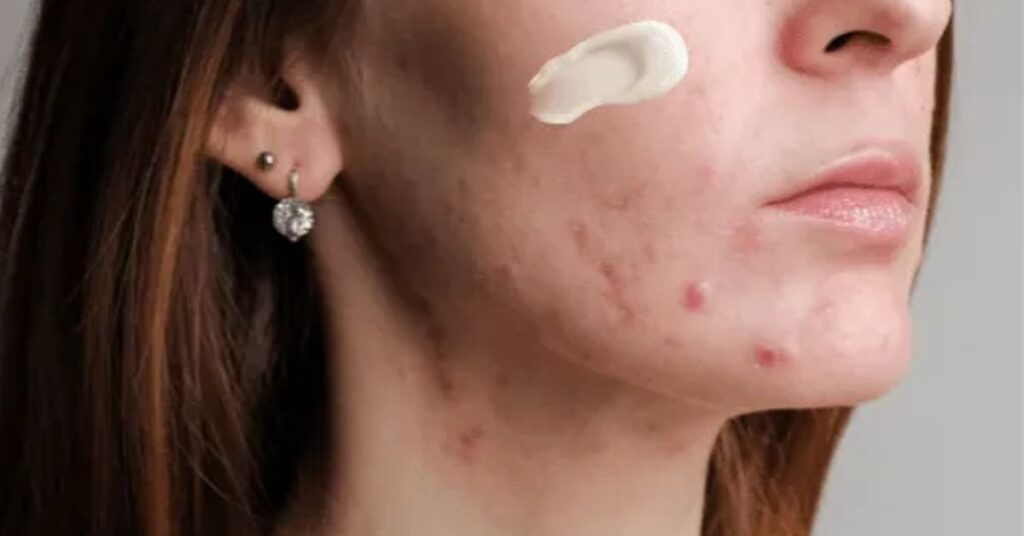 Principia kit anti-acne funciona: Principia kit anti-acne como usar? Confira