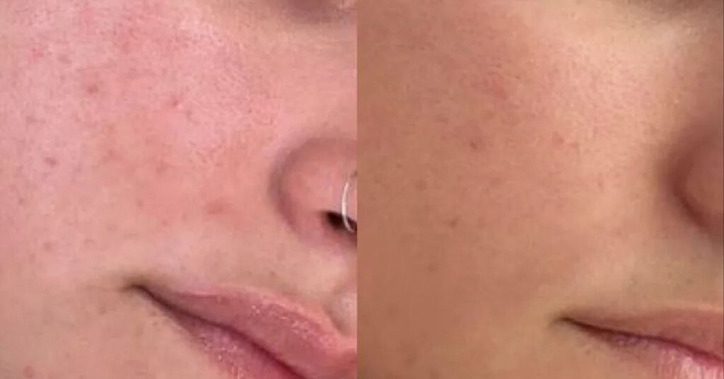 Principia sérum niacinamida: Será que o principia sérum niacinamida e zinco funciona