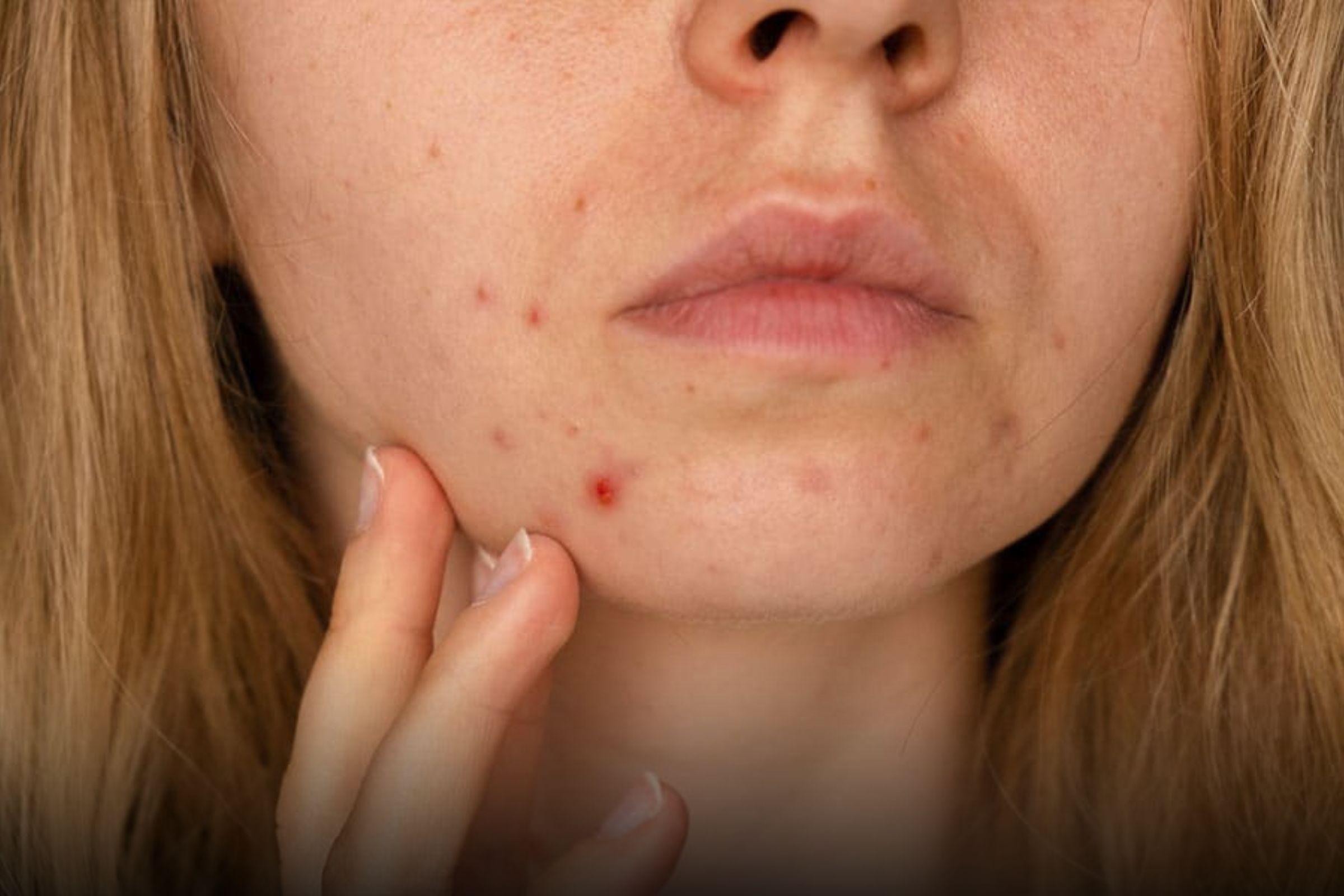 Principia é bom para acne: Saiba mais