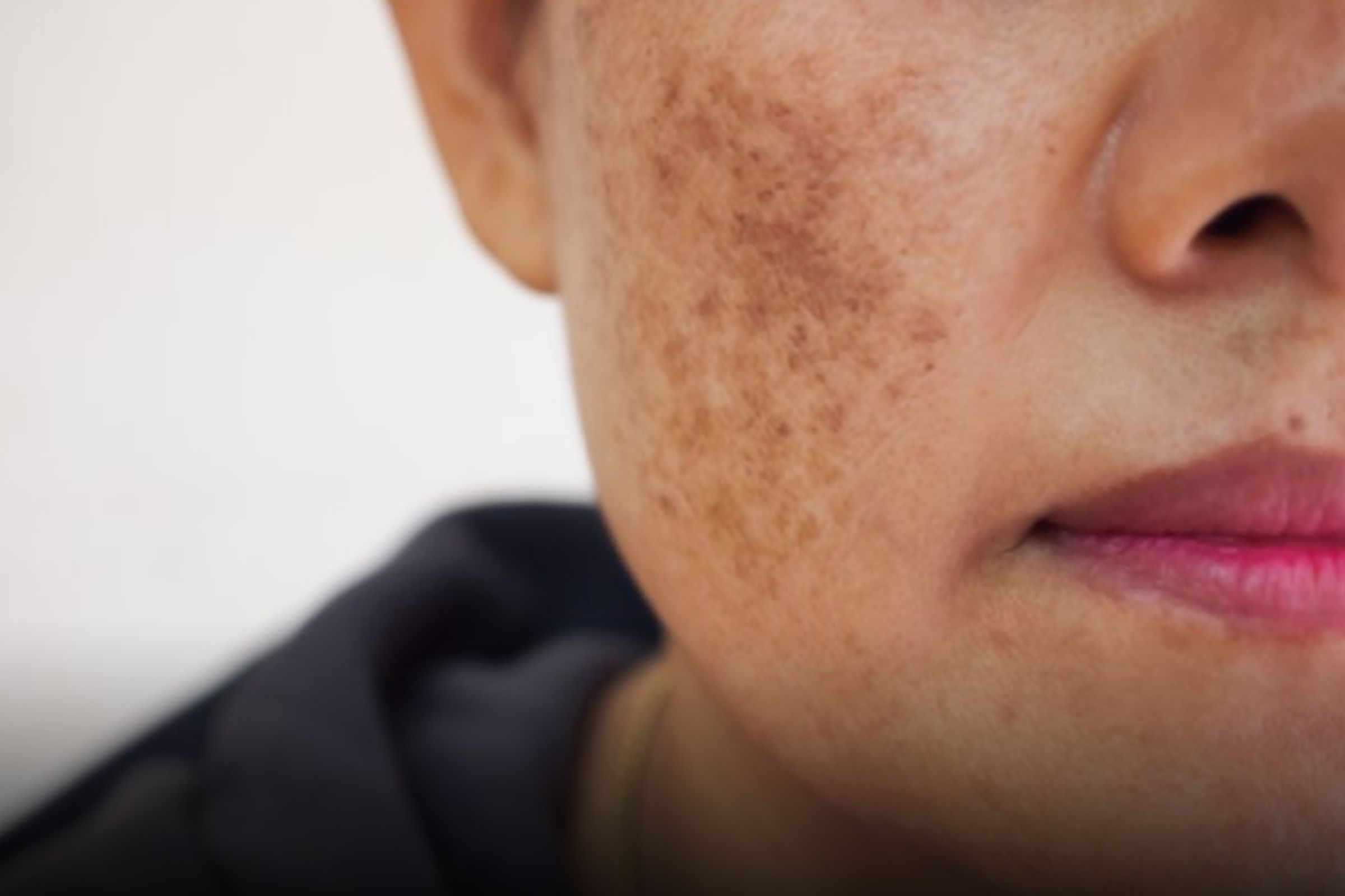 Qual Principia para Melasma: Descubra agora