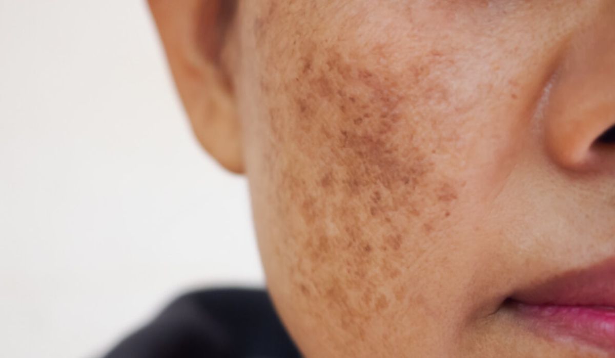 Qual Principia é bom para Melasma: Confira os 8 melhores