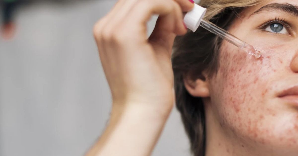 Principia kit anti-acne funciona: Principia kit anti-acne como usar? Confira