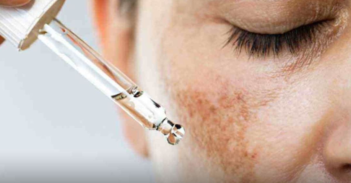 Principia melasma funciona, Principia melasma antes e depois, kit principia melasma, principia melasma resenha, principia melasma como usar, principia clareador melasma, kit principia melasma é bom, principia skincare melasma